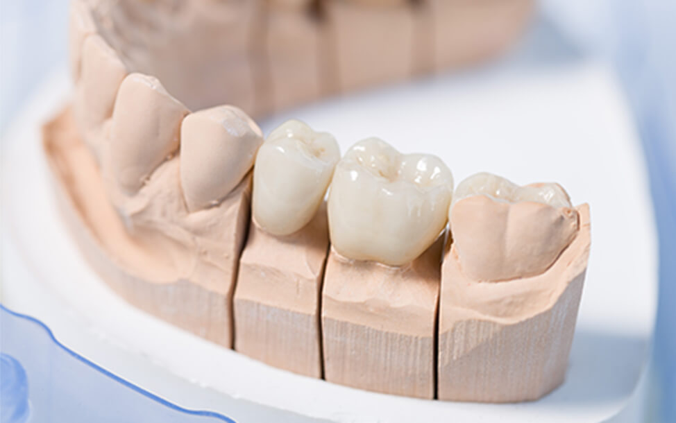 ジルコニアセラミック