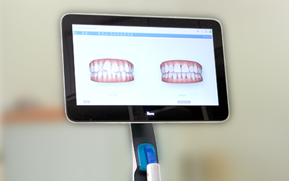 口腔内スキャナー「iTero」