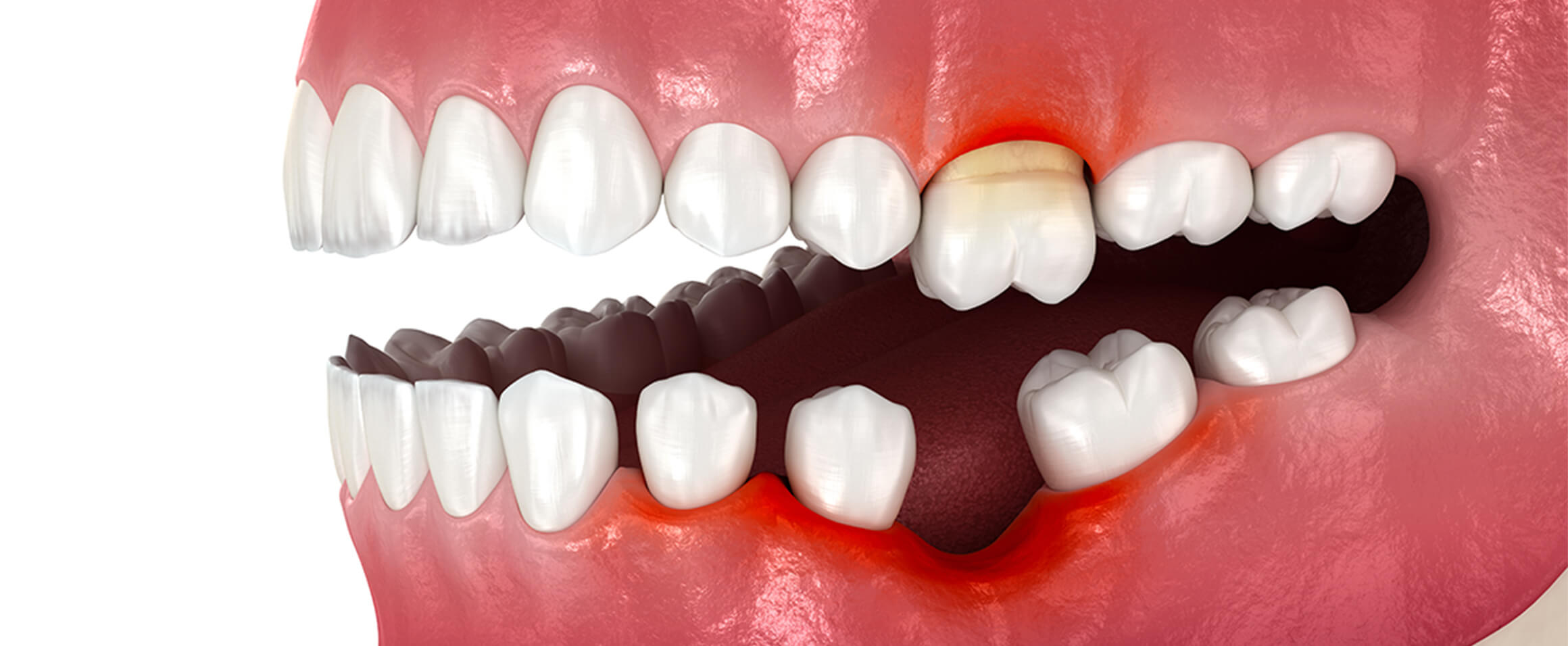 抜けた歯の治療