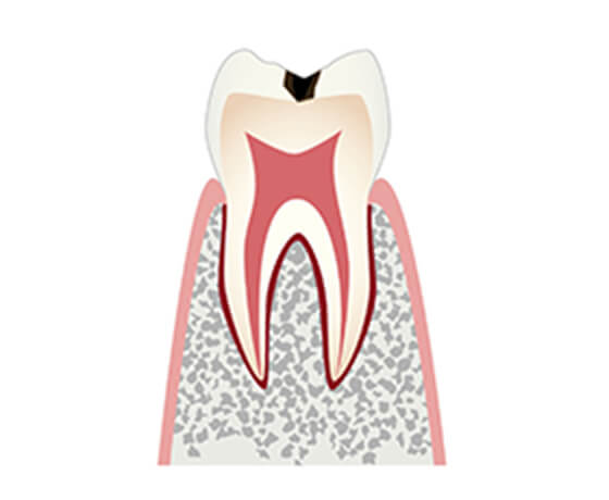 C1（エナメル質に穴があいた状態）