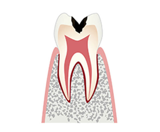 C2（象牙質まで到達した状態）