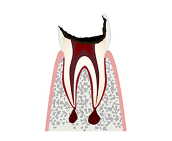 C4（歯の大部分を失った状態）