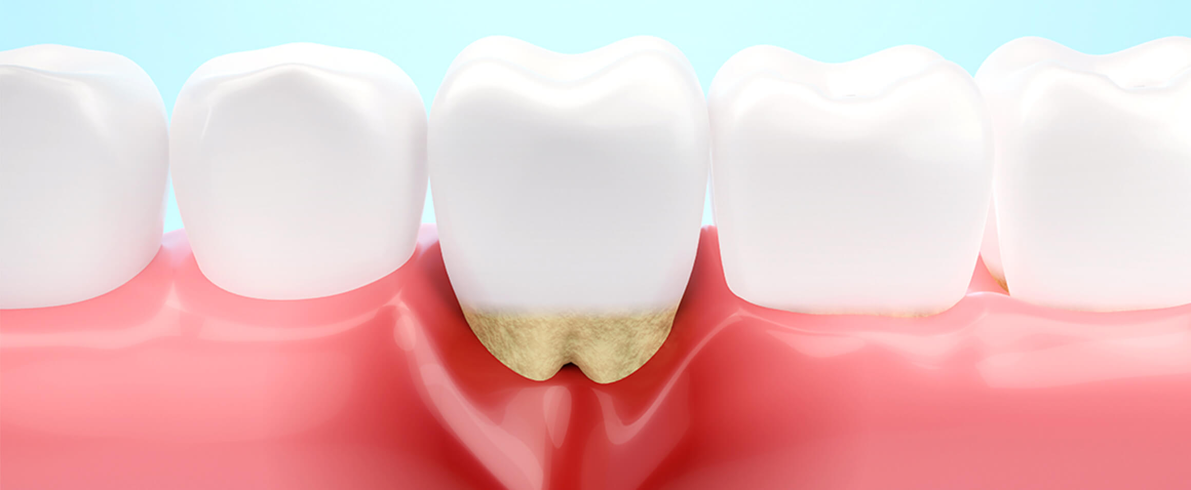 歯周病について