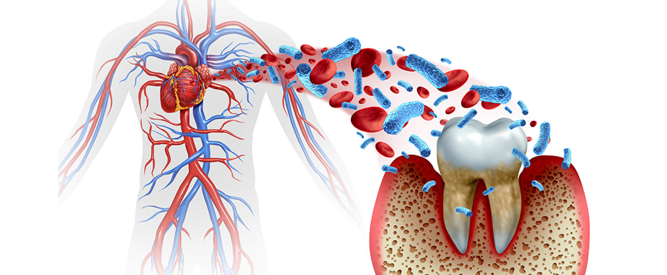 歯周病と全身疾患
