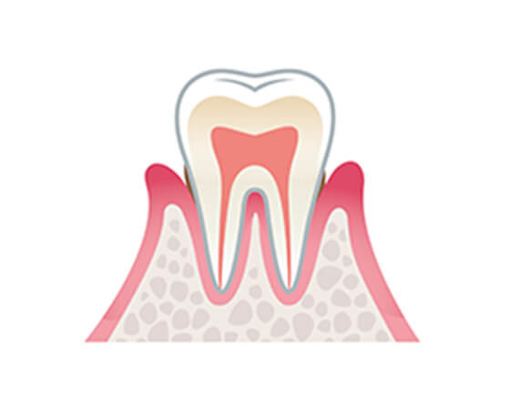 歯周炎（軽度）