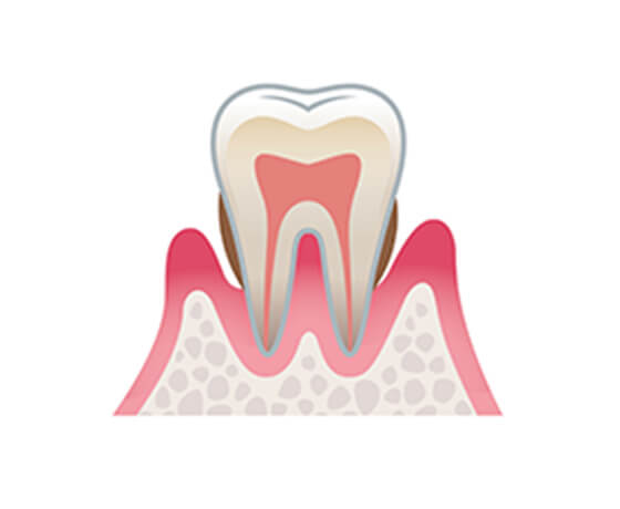 歯周炎（中度）