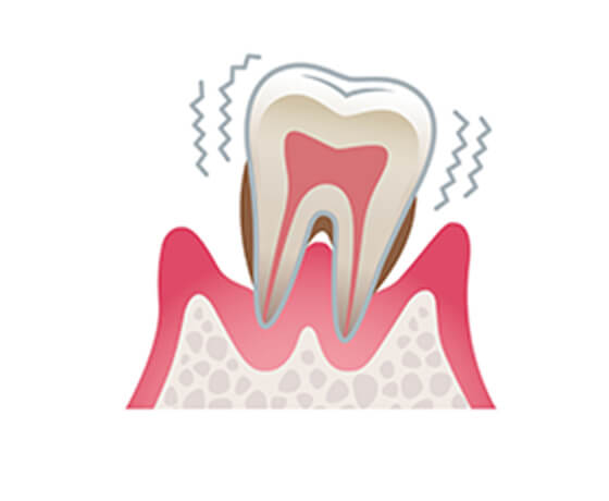 歯周炎（重度）