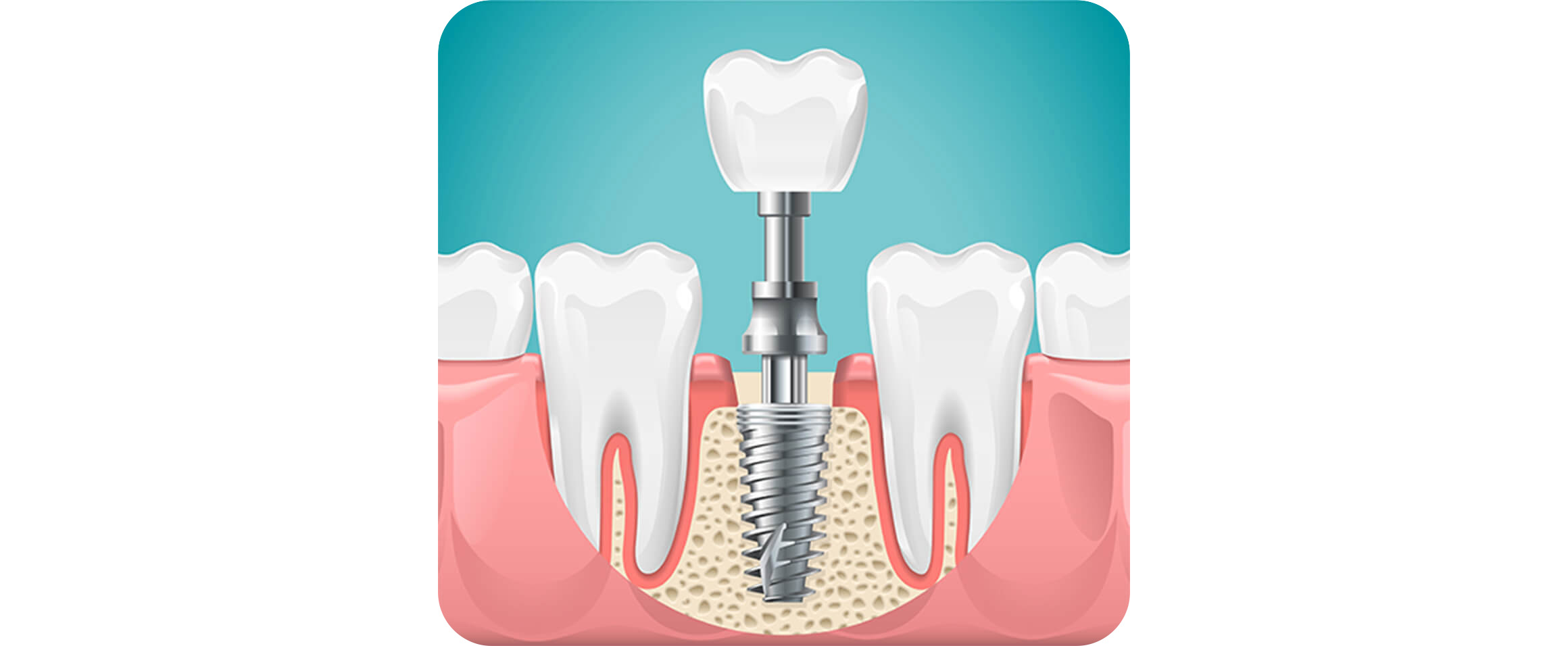 インプラント治療とは