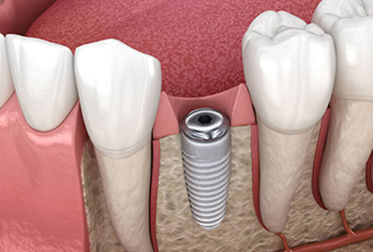 インプラント埋入手術