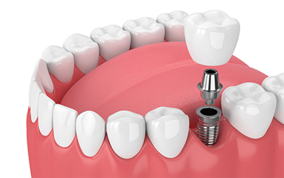 インプラント治療